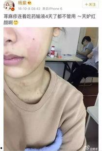 娱乐吃瓜酱过敏,吃瓜酱过敏背后的惊人真相  第2张 娱乐吃瓜酱过敏,吃瓜酱过敏背后的惊人真相  第2张