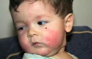 娱乐吃瓜酱过敏,吃瓜酱过敏背后的惊人真相  第3张 娱乐吃瓜酱过敏,吃瓜酱过敏背后的惊人真相  第3张